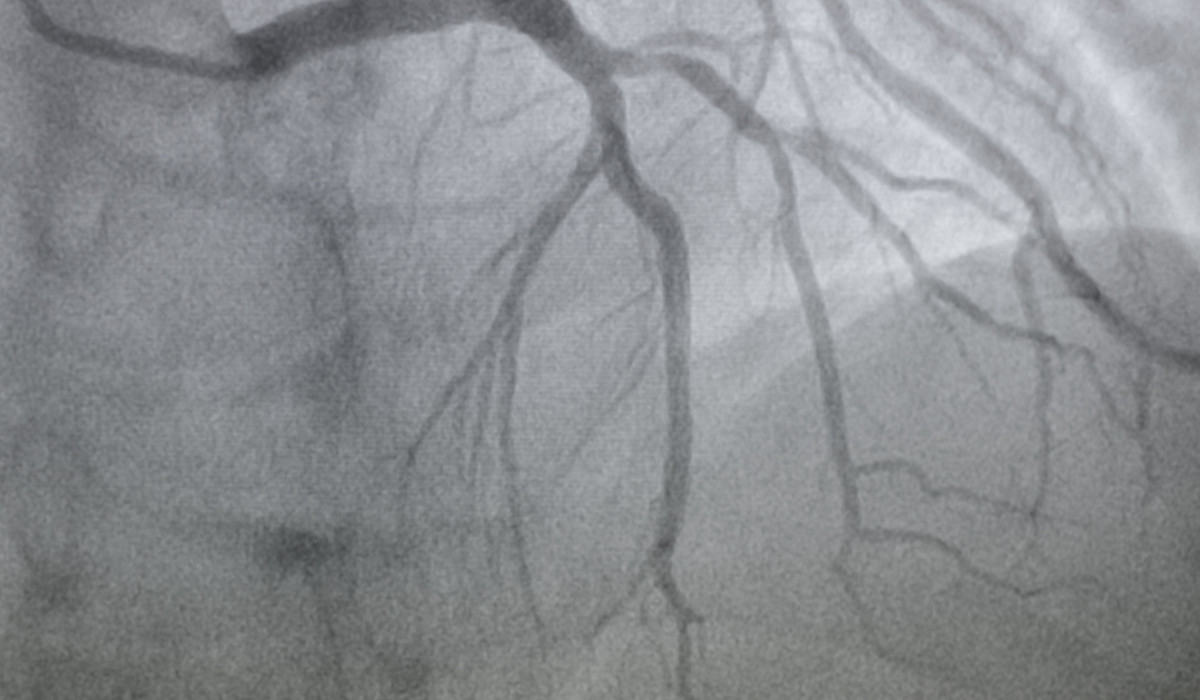 এনজিওগ্রাম কী? কেন করা হয়, পদ্ধতি, সময়, ঝুঁকি ও সতর্কতা