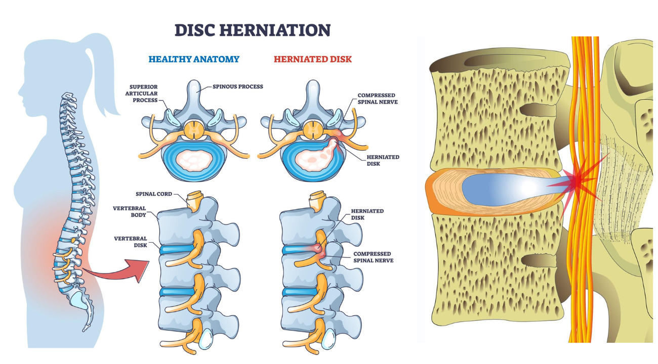 PLID Treatment Options in Bangladesh: What Patients Need to Know