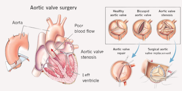 Aortic Valve Replacement with Ascending Aorta Replacement