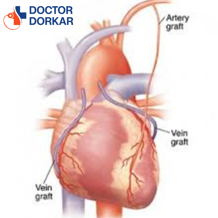 Off-Pump Coronary Artery Bypass Grafting in a 40 Years Male Patient