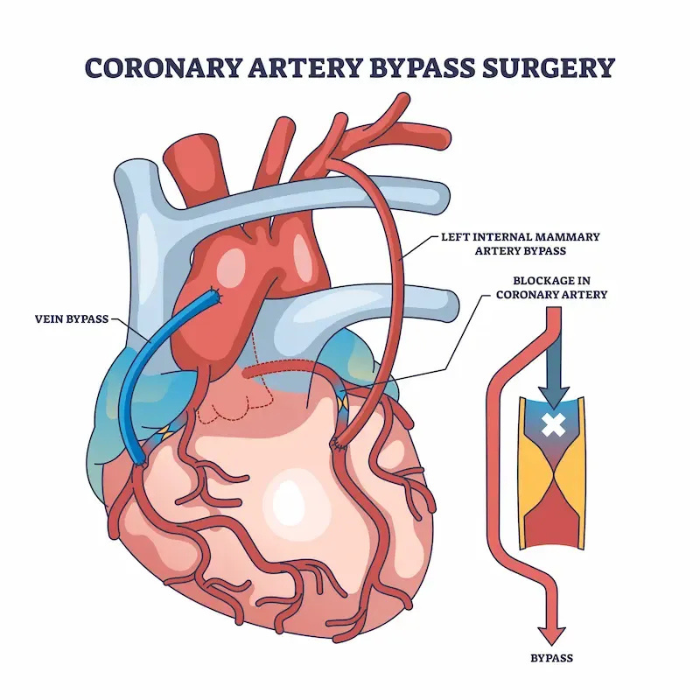 Off-Pump Coronary Artery Bypass Grafting in a 58-Year-Old Male with CAD (TVD)