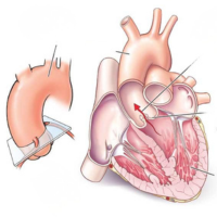 Aortic Valve and Aorta Replacement