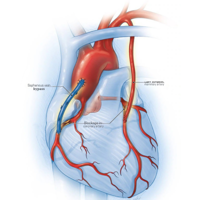 CABG / Heart Bypass Surgery