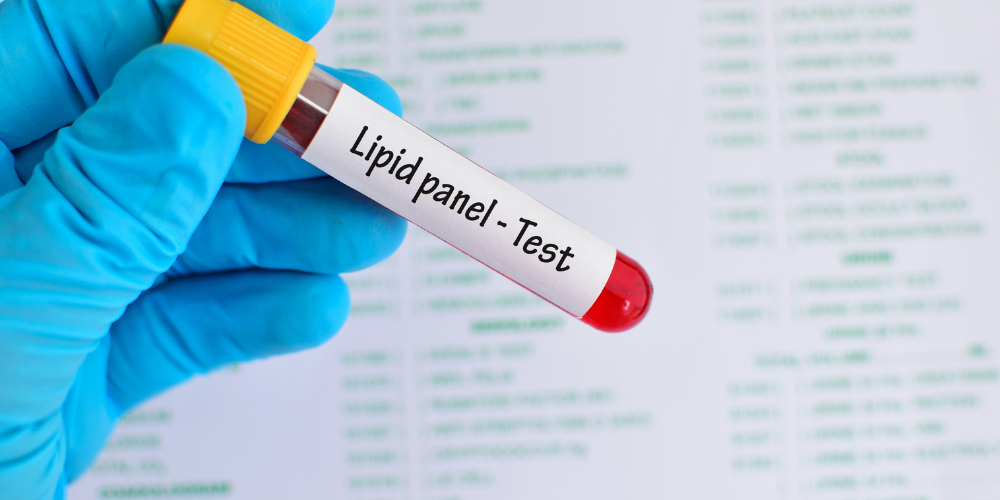 Lipid Profile Test Price in Bangladesh and Cost Details