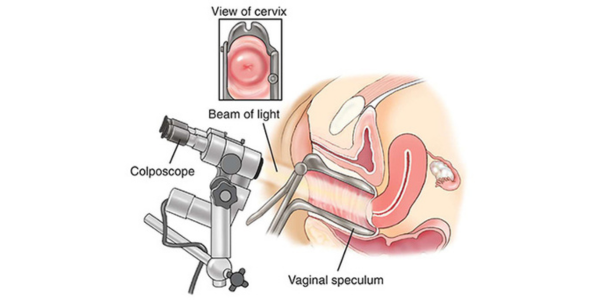 জরায়ু মুখ ও যোনিপথের ক্যান্সার শনাক্ত করতে কোলপোস্কপি