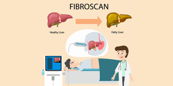 ফাইব্রোস্ক্যান কী? লিভার পরীক্ষার আধুনিক ও ব্যথামুক্ত পদ্ধতি