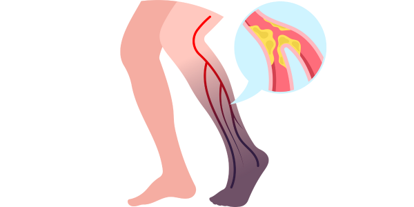 Peripheral Arterial Disease (PAD)